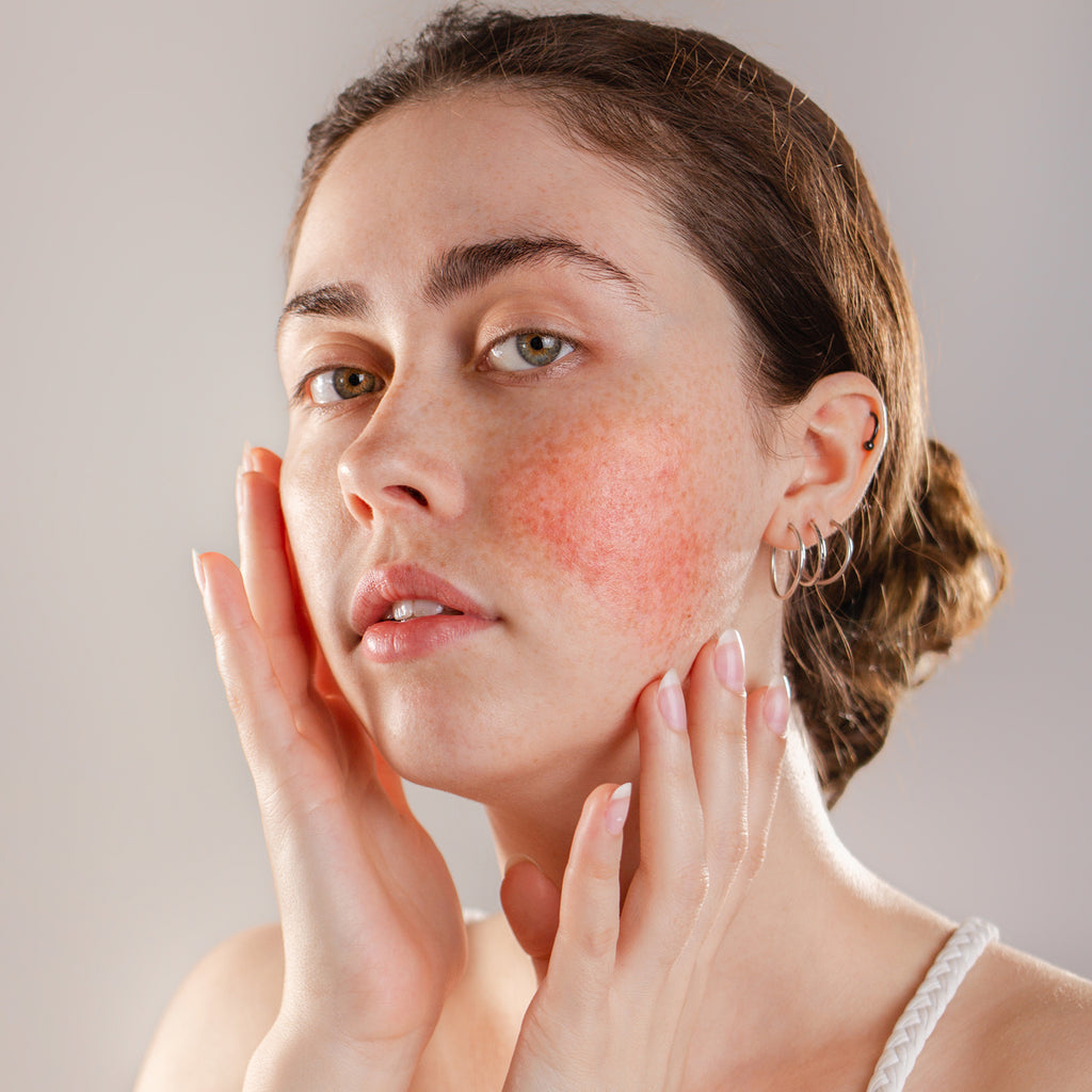 Understanding Rosacea, and creating a treatment plan for your aesthetic clients