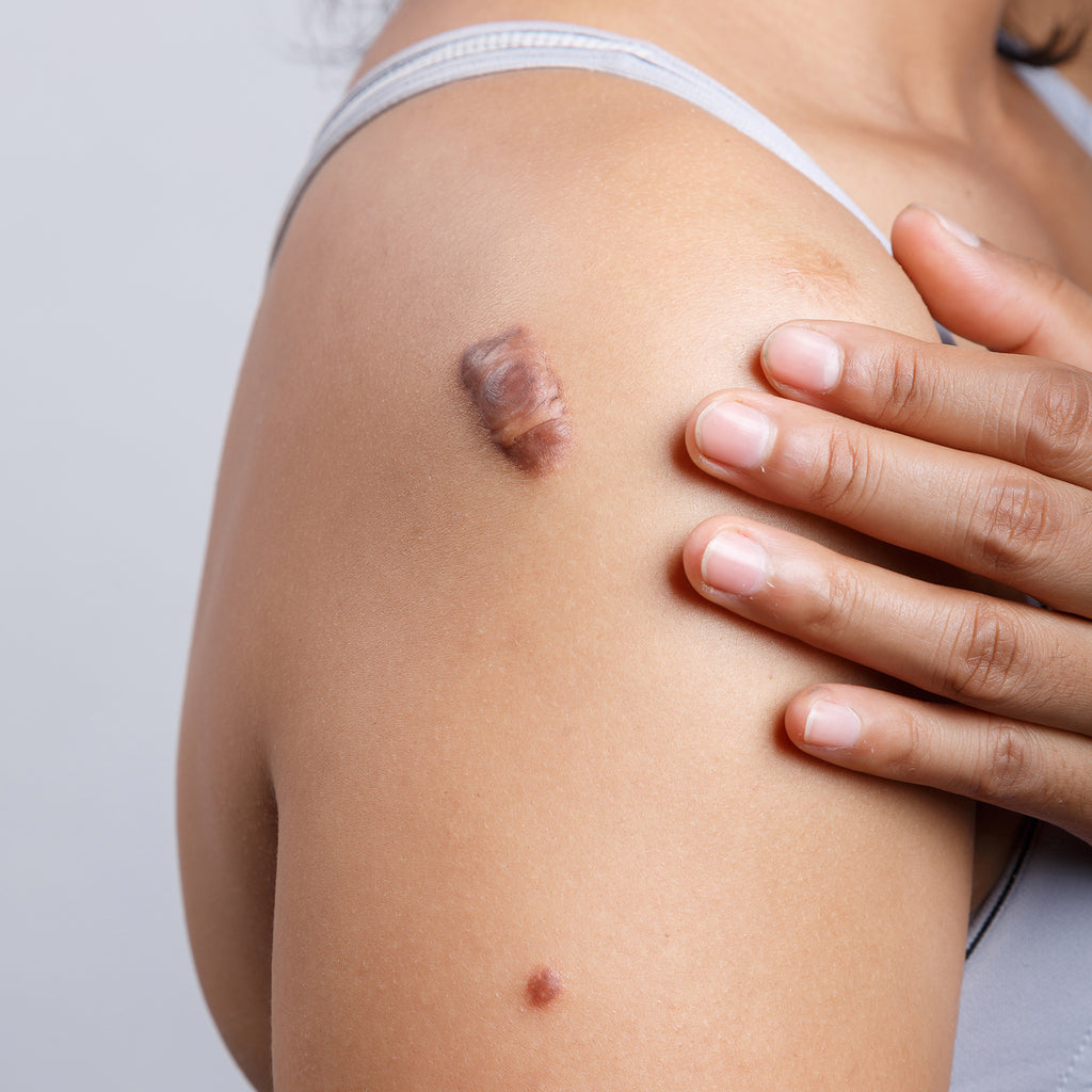 Breaking Through the Scars: Exploring the Latest Innovations in Keloid Treatment